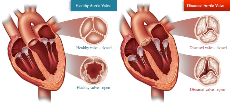 En rask og en syg aortaklap