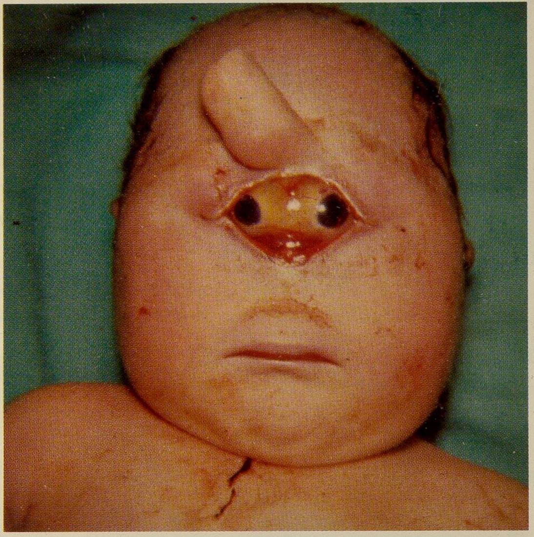 Cyclopia 2