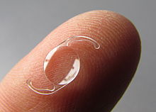 A one-piece intraocular lens resting on a fingertip for scale. The lens is about a quarter of the finger's width in diameter and has flexible haptic loops on opposite sides, which roughly double the length.