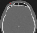 Impressionsbruch der Stirnhöhle in der Computer­tomo­graphie (Pfeil). Die hintere Stirnhöhlenwand zum Hirnschädel ist hier nicht betroffen.