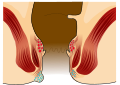 Grafische Darstellung einer Perianalthrombose