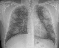 Xray of lungs, lighter patches visible