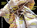 Carotid sinus