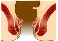 Hämorrhoiden ersten Grades