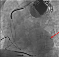 Thumbnail for Cardiac resynchronization therapy