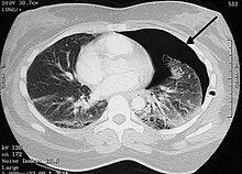 Pneumothorax CT.jpg