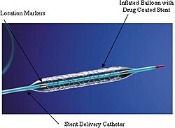 Koronar stent nümunəsi. Taksus stent dərmanı çıxaran stent kimi etiketlənir.