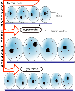 Hyperplasia vs Hypertrophy.svg