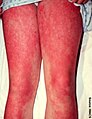 Linear extensor erythema. Intense erythema with Gottron's sign over the knees.