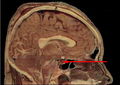 Localización de la glándula pituitaria en el cerebro humano.