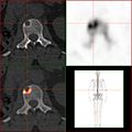 Vergleich ein und derselben Läsion des vorgenannten Patienten: Die Natriumfluorid-PET/CT-Aufnahme zeigt die Stoffwechselaktivität des Knochens als Reaktion auf den Tumor.