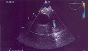 Thumbnail for Anomalous left coronary artery from the pulmonary artery