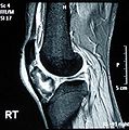 October 3: MRI scan of an osteochondroma.