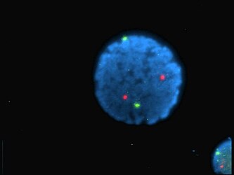 Núcleos de linfocitos humanos tinguidos con DAPI con sondas hibridadas nos centrómeros dos cromosomas 13 (verde) e 21 (vermello) (hibridación in situ fluorescente (FISH)).