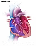 Thumbnail for Persistent truncus arteriosus