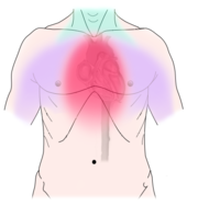 Angina pectoris -rintakivun esiintymisalue