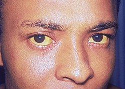 Jaundice eye.jpg