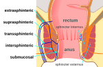 Thumbnail for Anal fistula