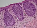 Carcinoma (epithelioma) basocellulare superficiale