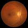 Thumbnail for Hypertensive retinopathy