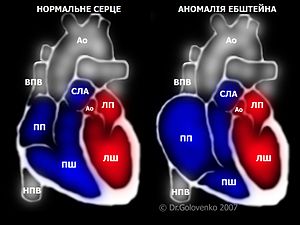 Порівняння анатомії нормального серця та анатомії серця з АЕ. Схематично зображена атріалізація правого шлуночку серця - збільшення розмірів правого передсердя та зменшення розмірів правого шлуночку. Позначення: Ао - аорта, СЛА - стовбур легеневоі артерії, ПП - праве передсердя, ПШ - правий шлуночок, ЛП - ліве передсердя, ЛШ - лівий шлуночок, ВПВ - верхня порожниста вена, НПВ - нижня порожниста вена